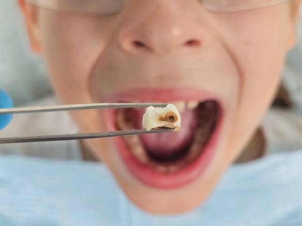 Best Emergency Treatment for Dental Infections or Abscesses in Milton, PA